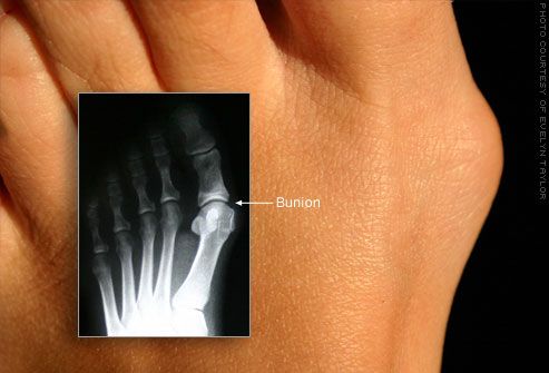 Deformácia palca na nohe typu bunion vulgus