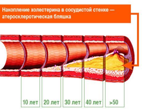 Bolo odhalené, ktoré aterosklerotické plaky sú zodpovedné za mozgové príhody