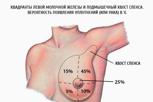 Ľavé kvadranty prsníka a axilárna časť Spenceovho chvosta. Pravdepodobnosť vzniku hrčiek (alebo rakoviny) v %