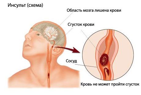 Jednoduchý test predpovedá smrteľnú mozgovú príhodu