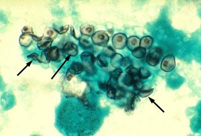 Pôvodca pneumocystózy (Pneumocystis jiroveci)